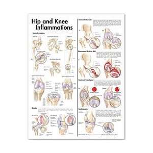  Hip and Knee Inflammations Anatomical Chart 2nd Edition 