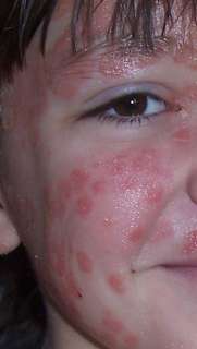 Best Acne Blackhead Spot Blemish Treatment Spray **  